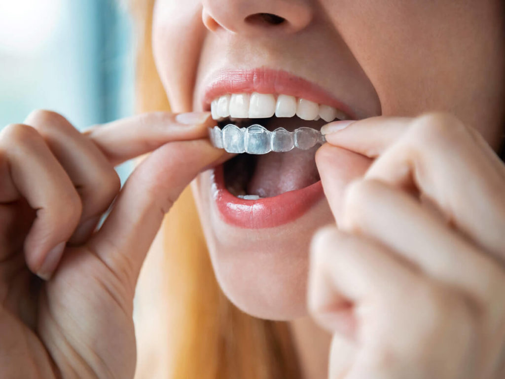 A woman fitting an invisalign clear aligners tray