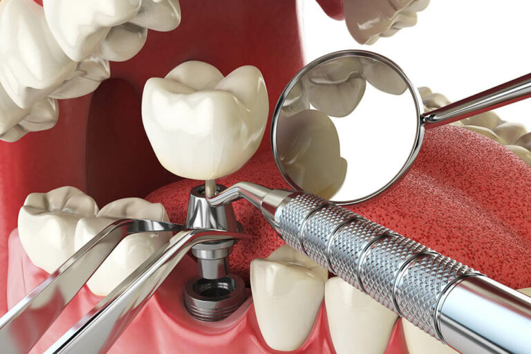 A 3D mockup of a dental implant being placed