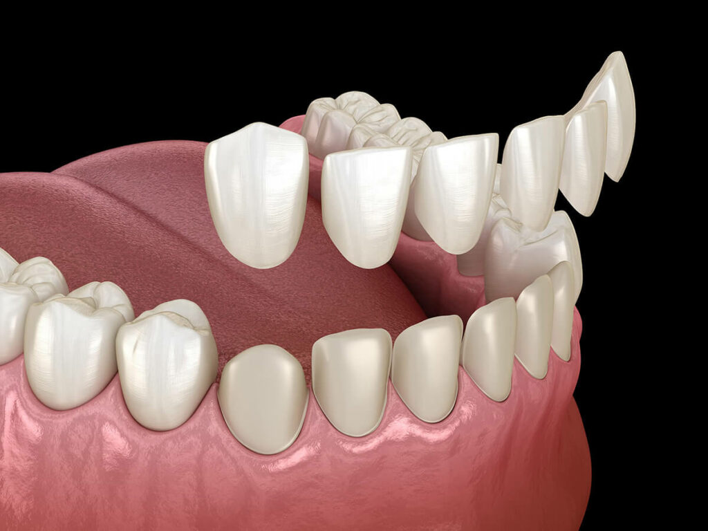 A 3D mockup of dental veneers fitting over front teeth