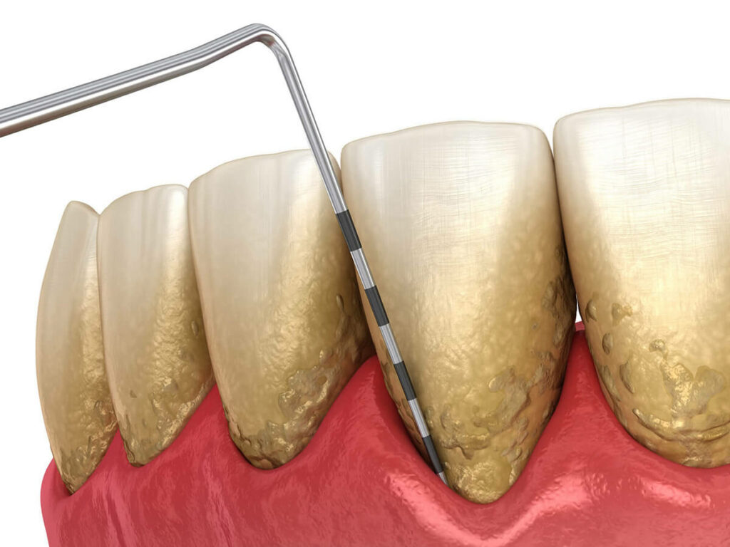 Gums being affected by periodontal disease