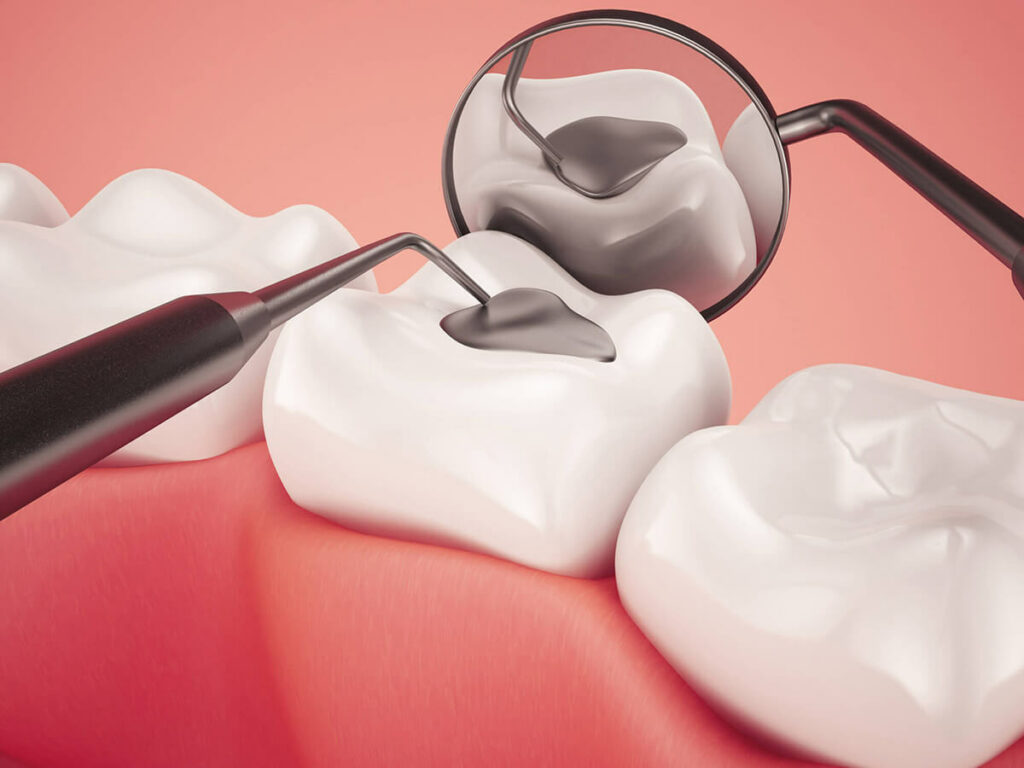 An illustration of a dental filling being placed