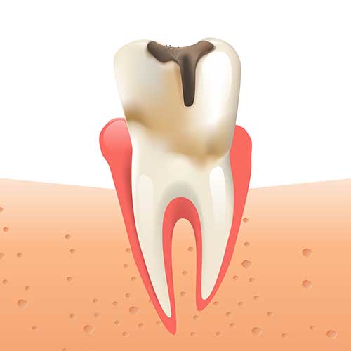 An illustration of a decayed tooth